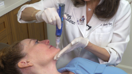 acne scars, SkinPen, Bellus Medical, microneedling system, treat facial acne scars, get rid of acne scars, fda approved, lifeminute, lifeminute.tv, sponsored